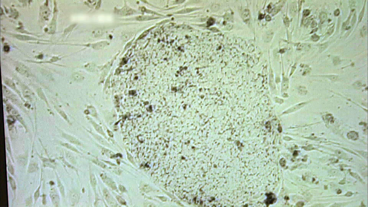 배아줄기세포 이식 1년…<br>파킨슨 환자 “탁구·배드민턴도 해요”